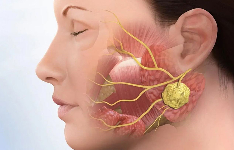 Bệnh viêm khớp thái dương hàm có thể gây nổi hạch, đau đớn ở vùng mang tai