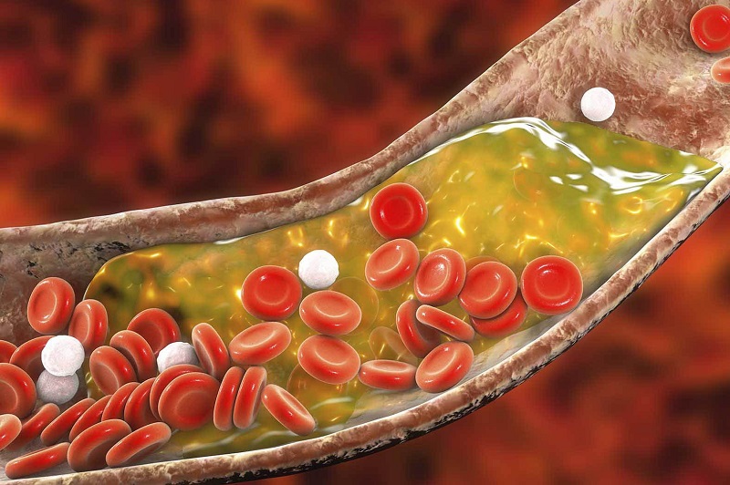 Cholesterol cao làm gia tăng nguy cơ mắc các bệnh tim mạch, cản trở lưu thông máu