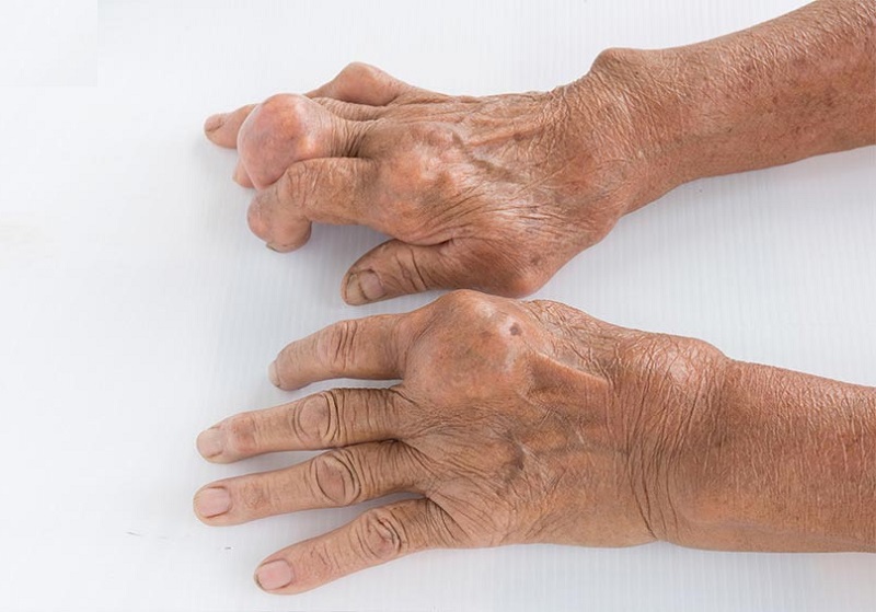 Bệnh gout không thể chữa khỏi và có thể làm biến dạng các khớp xương