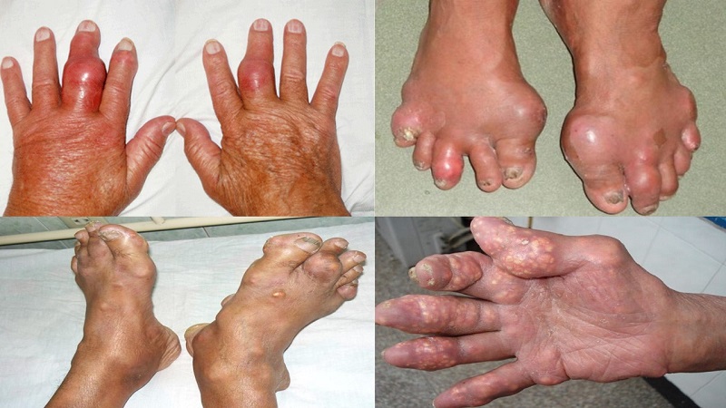 Bệnh gout gây ra nhiều biến chứng nguy hiểm nhưng không có khả năng lây nhiễm