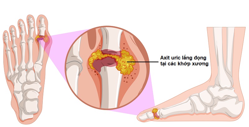 Rối loạn chuyển hóa acid uric trong cơ thể chính là nguyên nhân hình thành bệnh gout